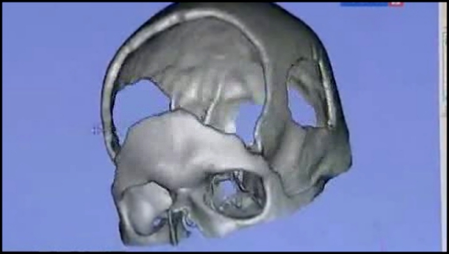 3D-череп от пластических хирургов 