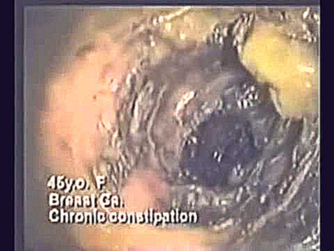 Видео толстого кишечника изнутри 