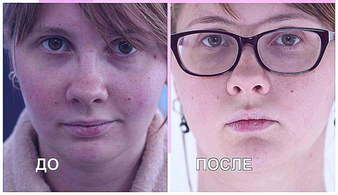 Перезагрузка: Как избавиться от шелушения, воспаления кожи лица 